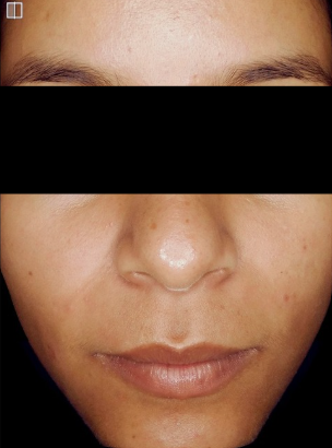 acne treatment after treatment photo