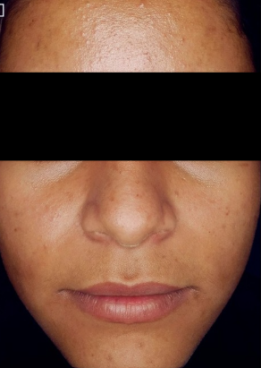 acne treatment before treatment photo