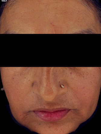 Botox after treatment photo