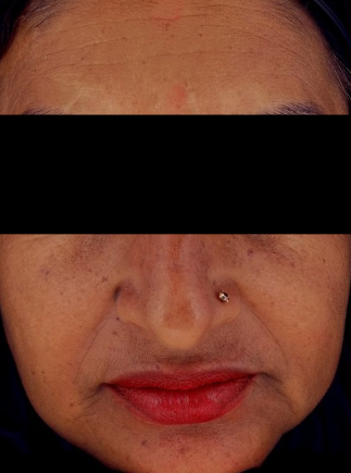Botox before treatment photo