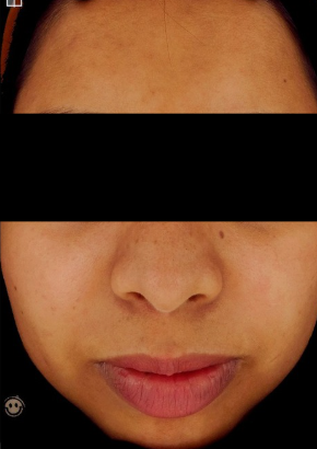 Carbon peel after treatment photo