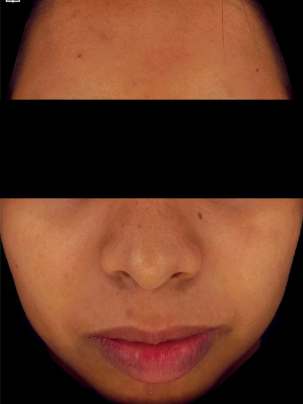 Carbon peel before treatment photo