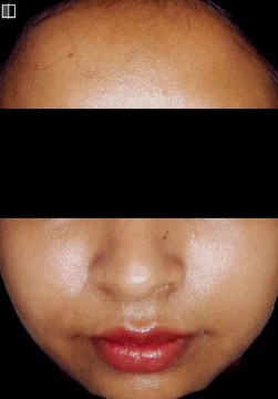 chemical peel after treatment photo
