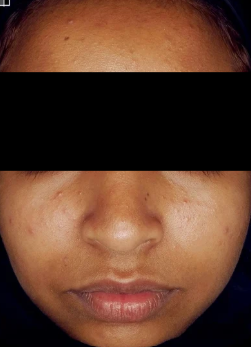 chemical peel before treatment photo