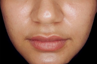 Derma filler after treatment photo
