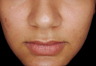 Derma filler before treatment photo