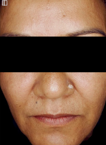 Exosome after treatment photo