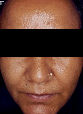 Exosome before treatment photo
