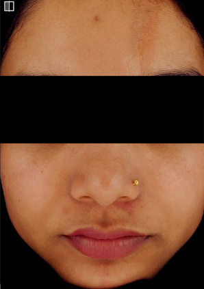 GFC face after treatment photo