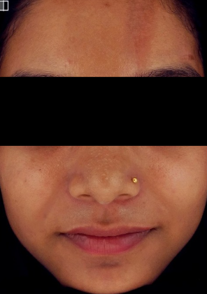 GFC face before treatment photo