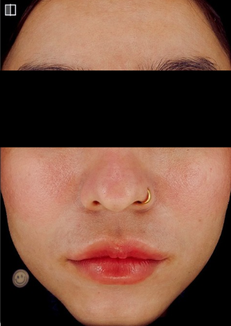 HIFU after treatment photo