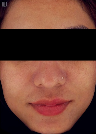 HIFU before treatment photo