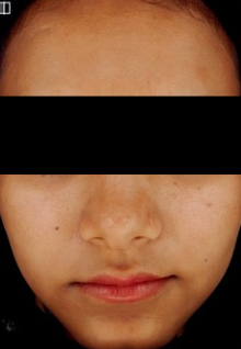 Lasemd after treatment photo
