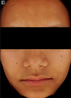 Lasemd before treatment photo