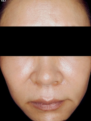 PDLLA after treatment photo