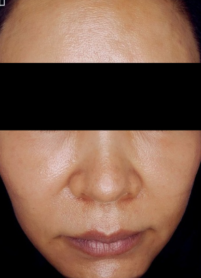 PDLLA before treatment photo