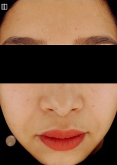 PDRN & PN after treatment photo