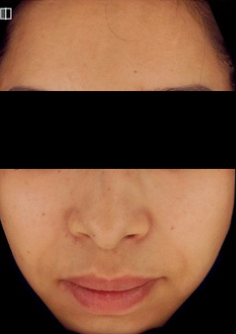 PDRN & PN before treatment photo