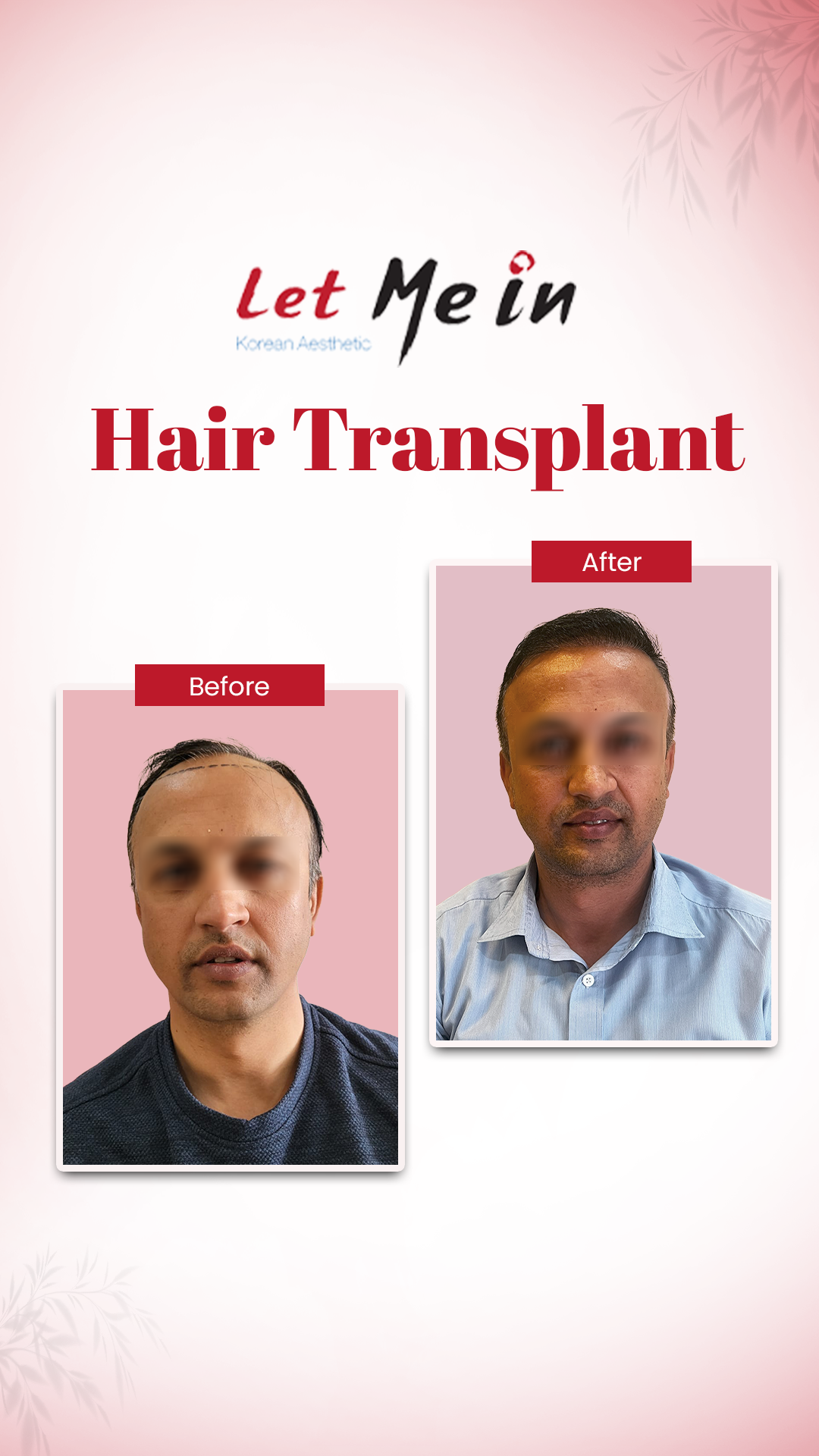 Hair Transplant - Featured Image