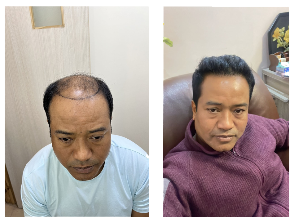 Hair transplant treatment