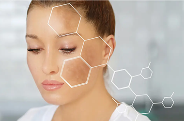 Melasma treatment