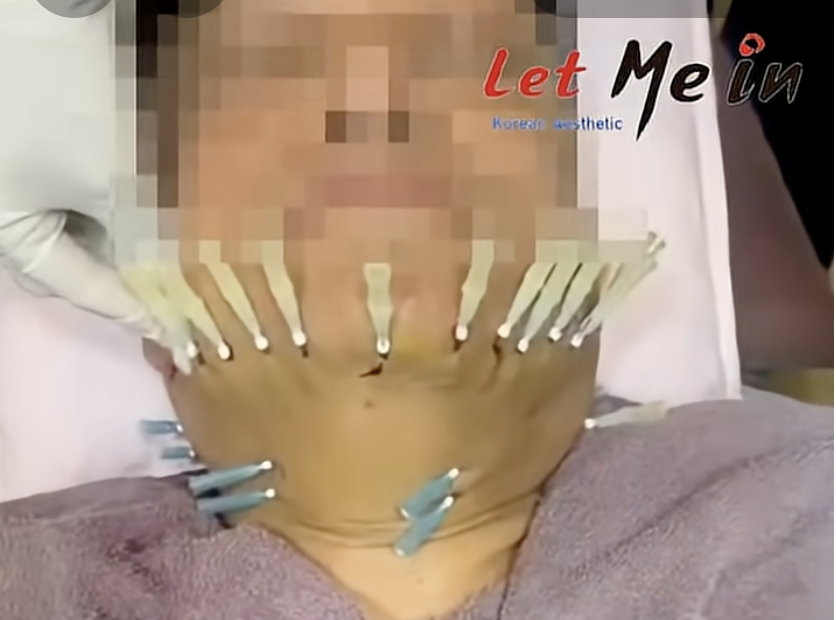 Thread lift treatment in Nepal at Let Me In Skin Clinic