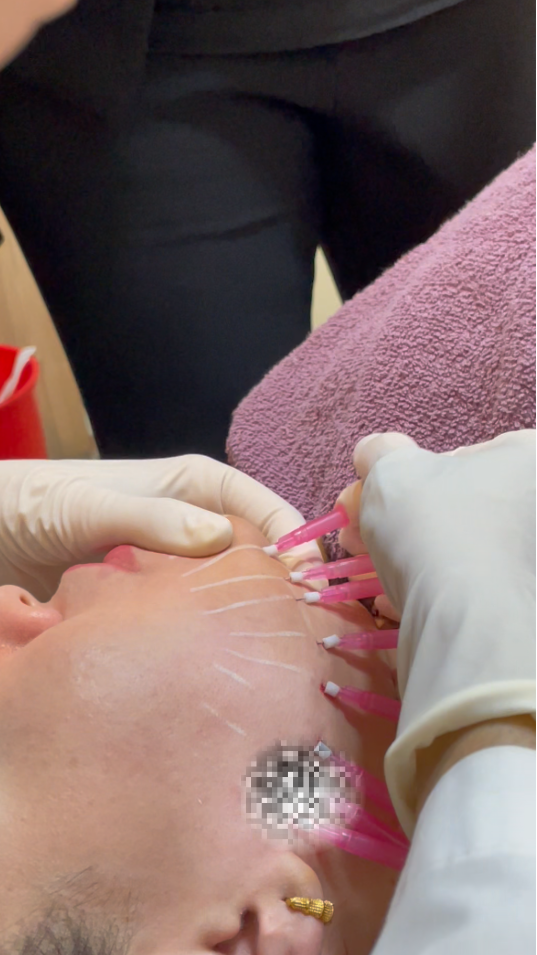 Thread Lift treatment