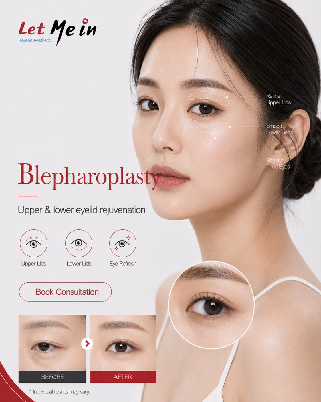 Blepharoplasty eyelid surgery in Kathmandu Nepal