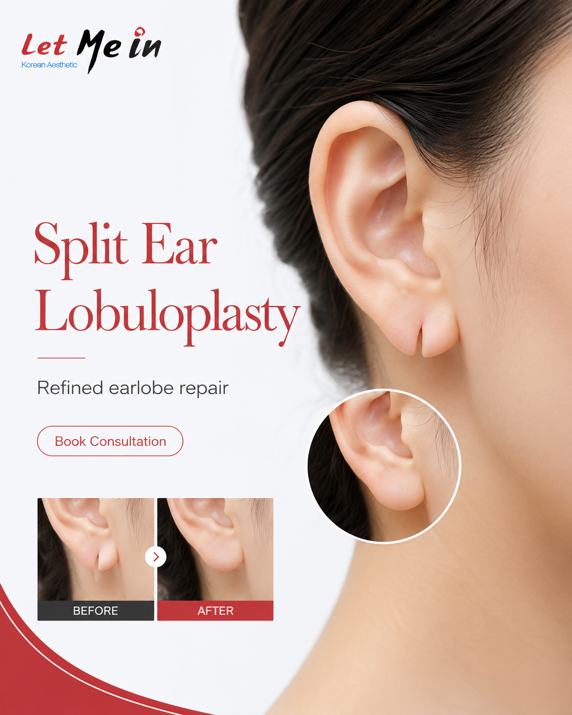 Split earlobe repair in Kathmandu