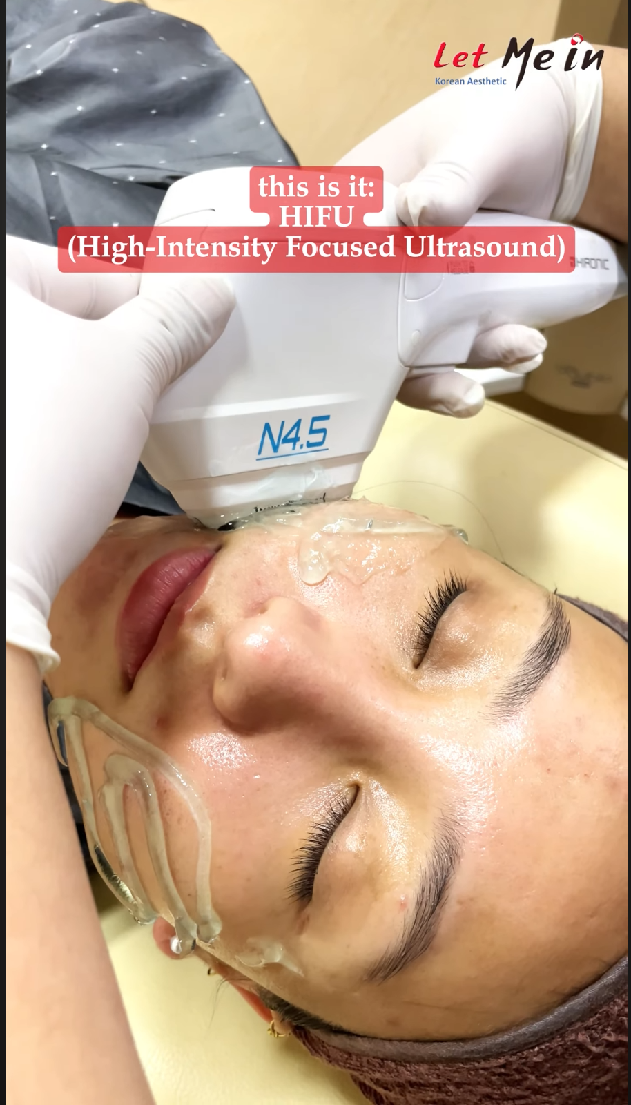 PDLLA (Juvelook) treatment