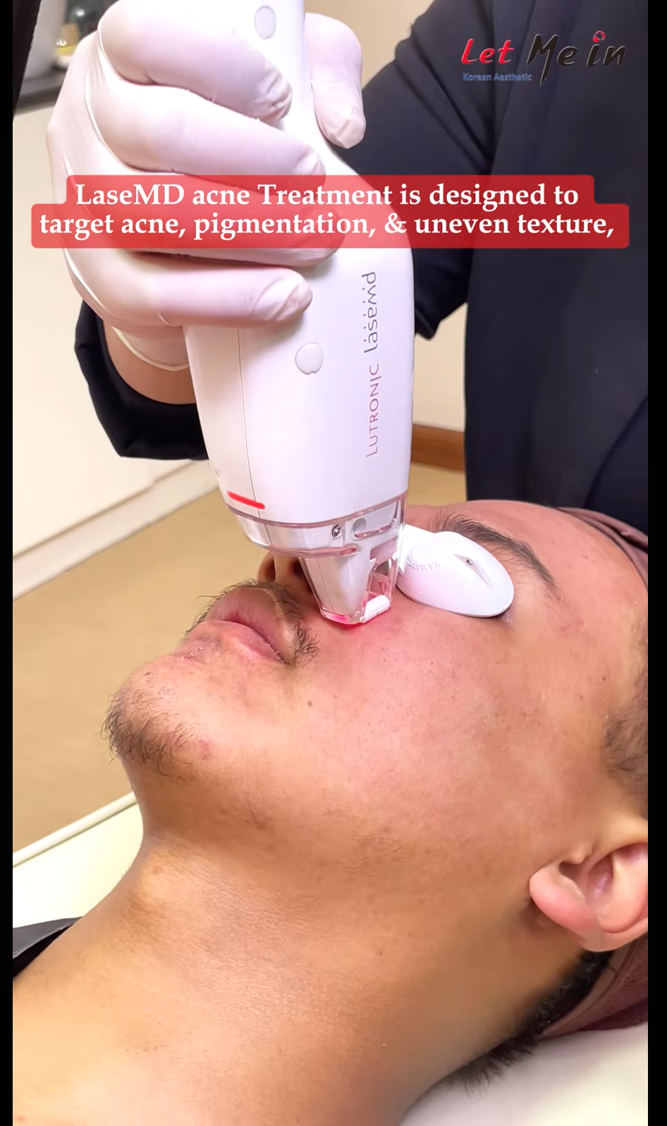 LaseMD male skin treatment session