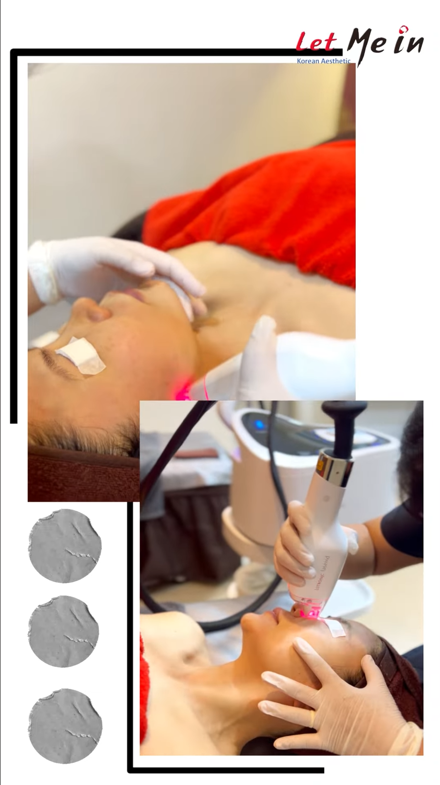 LaseMD for pigmentation at Let Me In