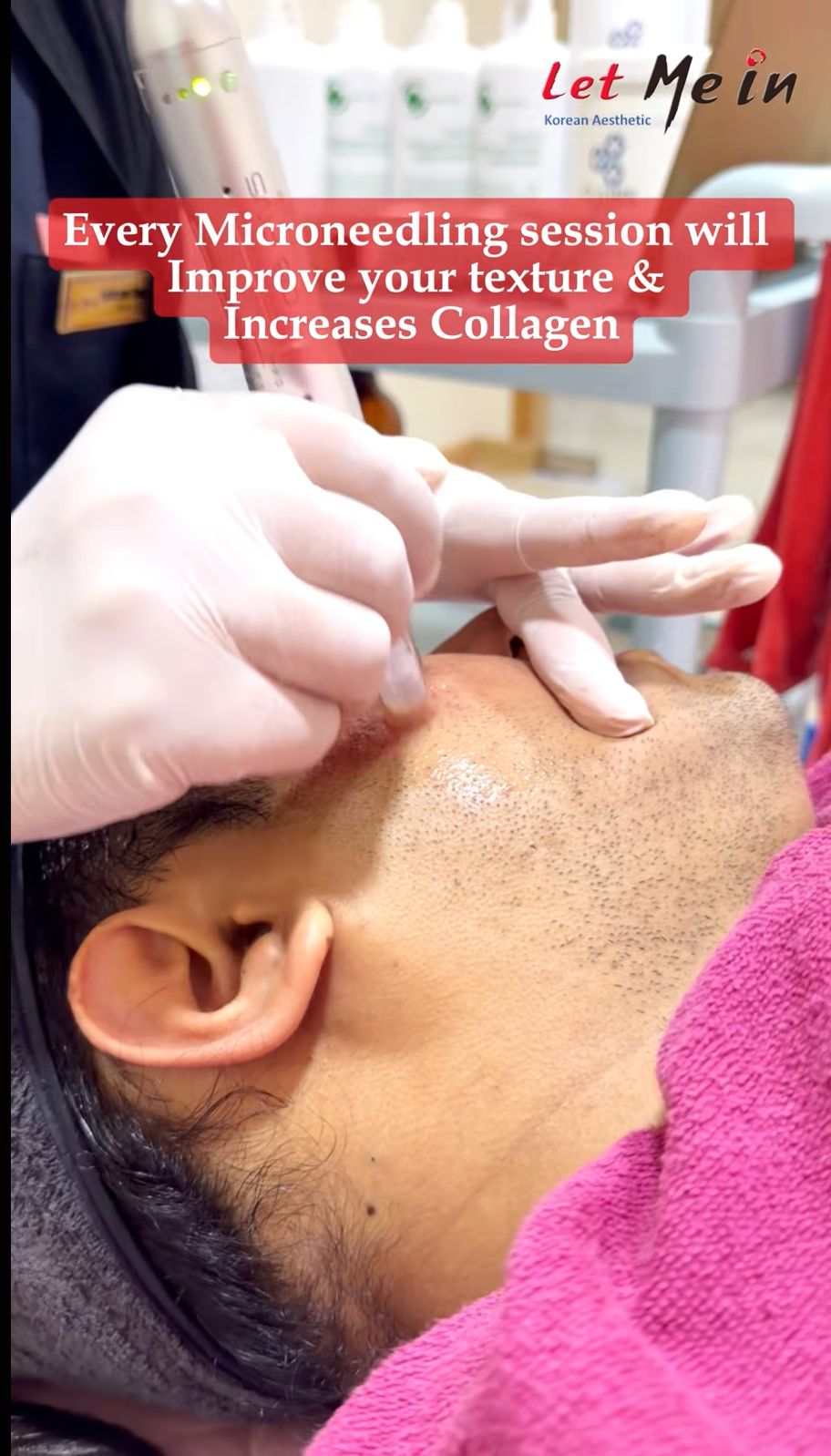 Microneedling treatment Pokhara by dermatologists