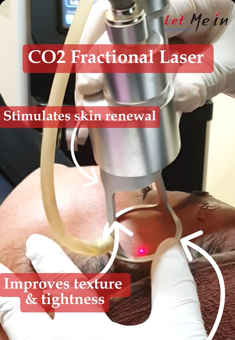 CO2 laser method for skin tag removal at Let Me In