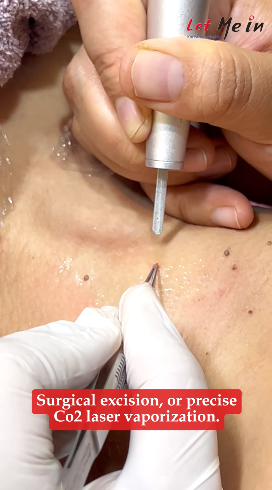 Skin tag removal Pokhara by MD dermatologist