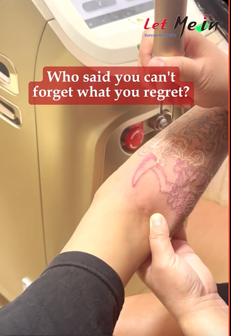 Tattoo removal laser treatment Kathmandu clinic